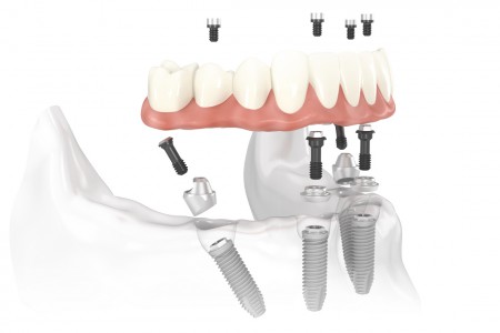 Denti Fissi in 8 Ore